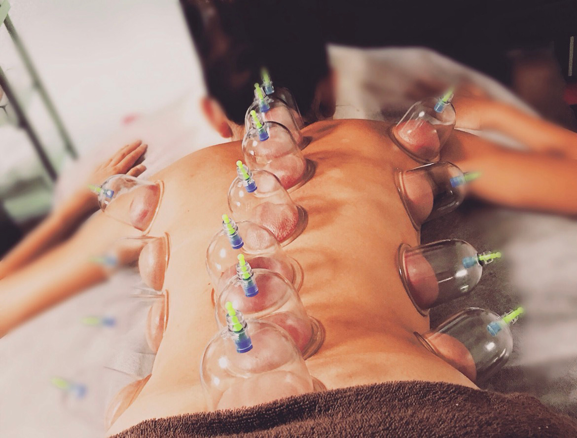Cupping